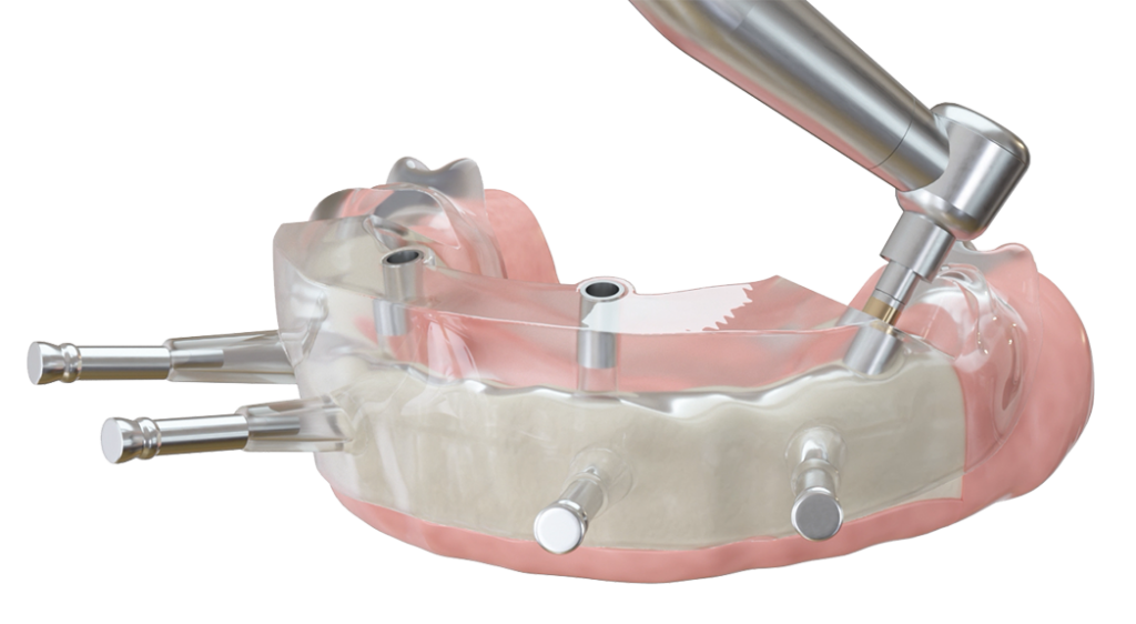 All-On-4-Implantattechnik — Zahnarzt in Erlensee
