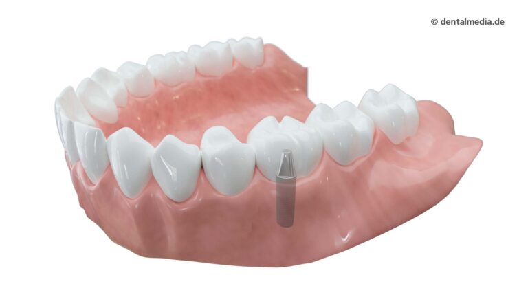Ästhetische Zahnmedizin — Zahnkronen aus Vollkeramik — Zahnarzt in Erlensee