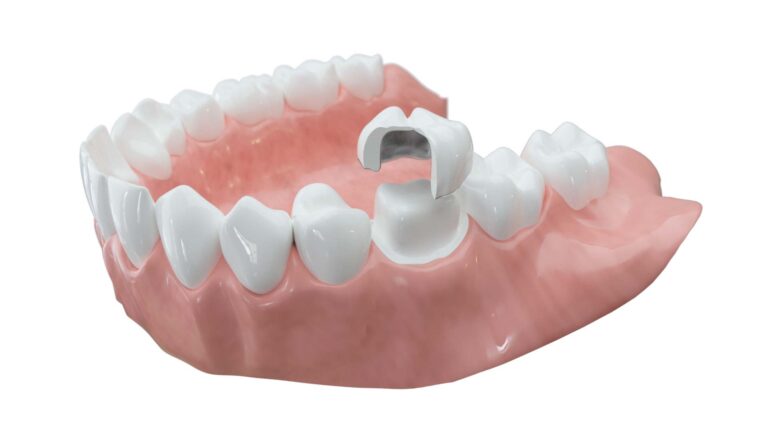 Ästhetische Zahnmedizin — Zahnkronen aus Keramik — Zahnarzt in Erlensee