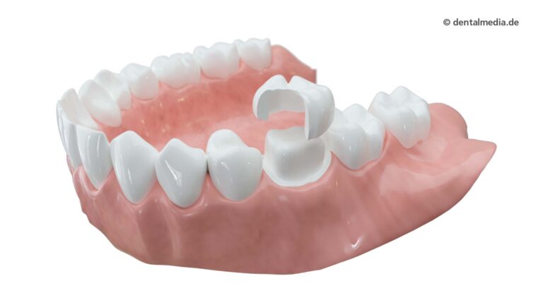 Ästhetische Zahnmedizin — Zahnkronen aus Vollkeramik — Zahnarzt in Erlensee