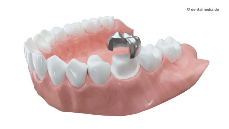 Ästhetische Zahnmedizin — Zahnkronen aus Metall — Zahnarzt in Erlensee