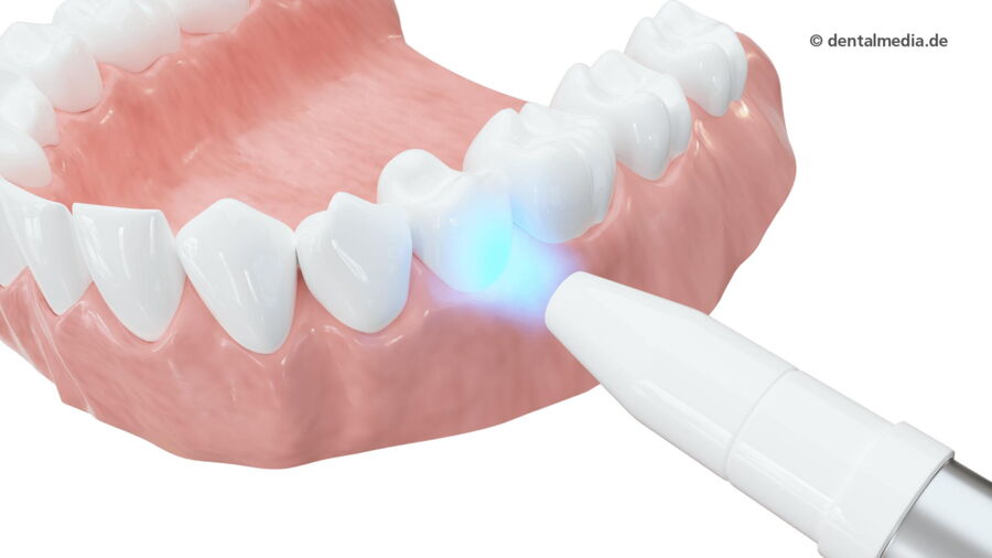 Laser Bleaching — Zahnarzt in Erlensee