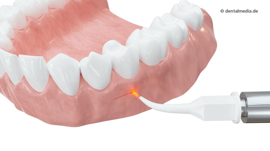 Dentallaser — Zahnarzt in Erlensee