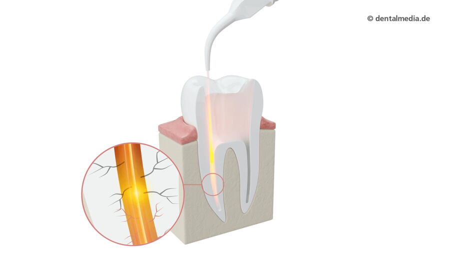 Dentallaser Wurzelbehandlung — Zahnarzt in Erlensee