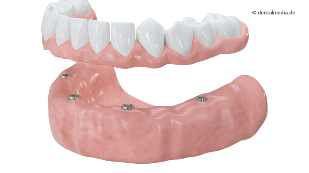 Zahnprothese — Zahnarzt in Erlensee