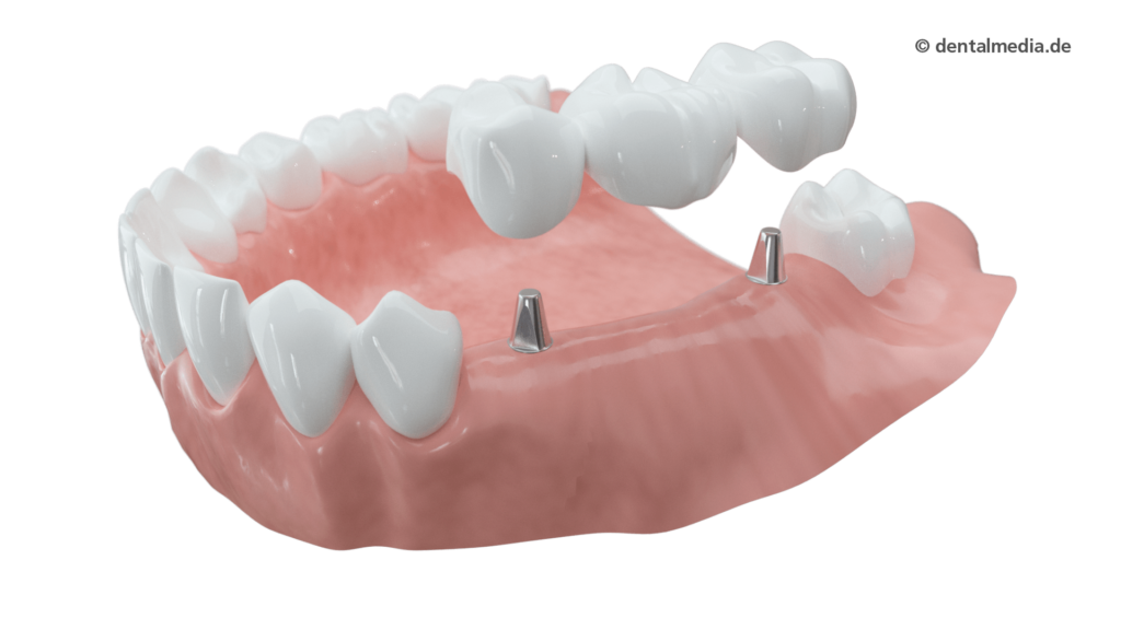 Schaltlücke — Zahnarzt in Erlensee