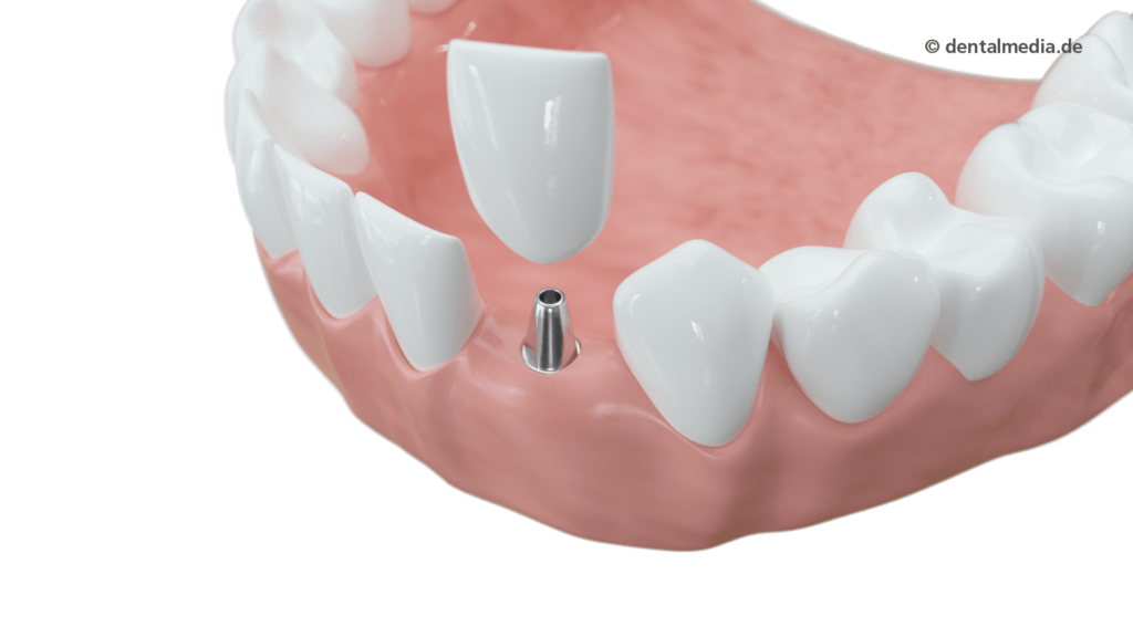 Schaltlücke — Zahnarzt in Erlensee